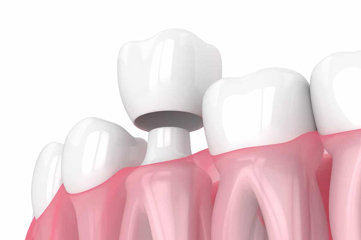 Dental crowns vs fillings which is the better option for tooth repair blog