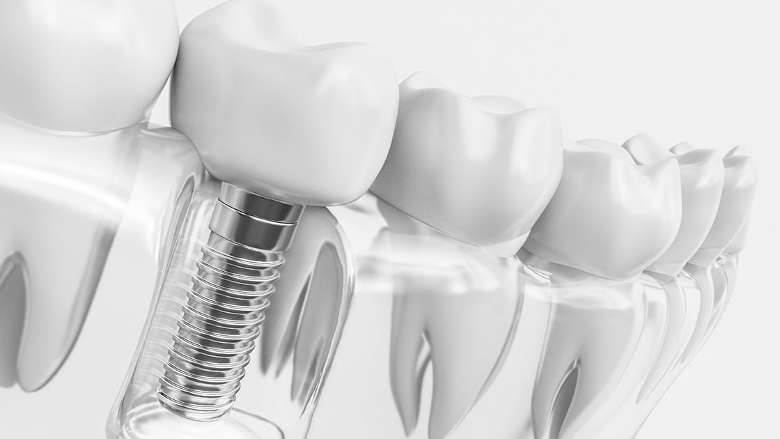 Implant