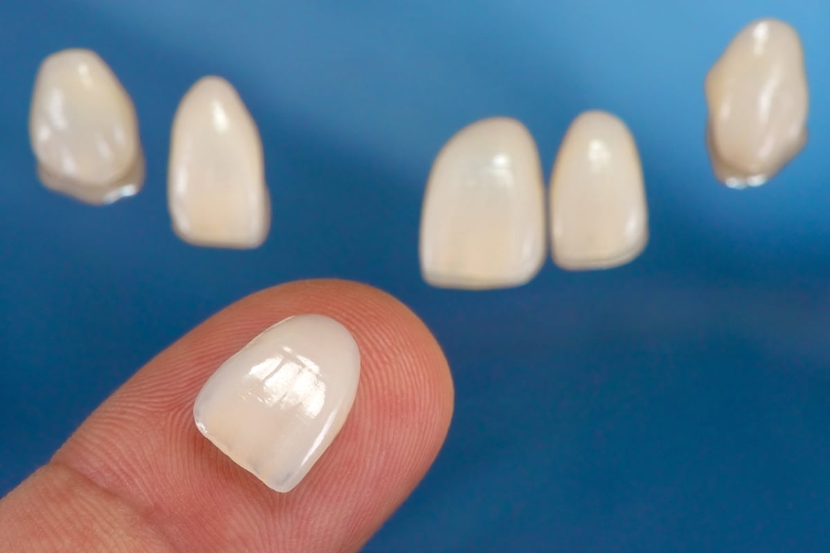 Teeth whitening vs veneers which is right for your smile goals blog